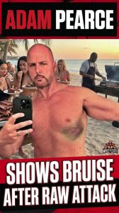Adam Pearce Shows Bruise After RAW Attack